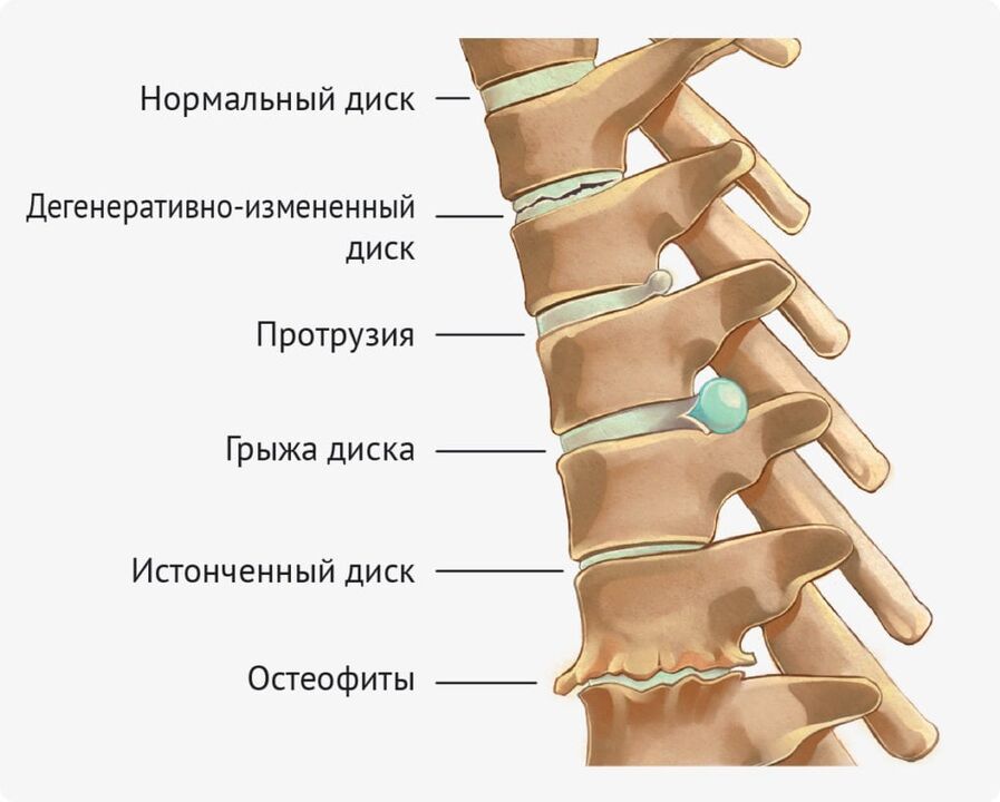 Lomber osteokondroz için disk deformiteleri