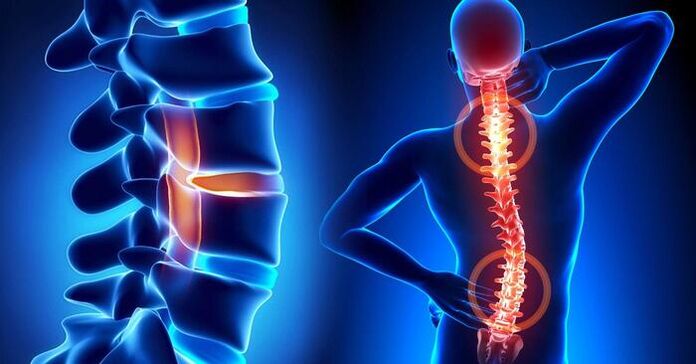 Osteokondrozda ağrının lokalizasyonu