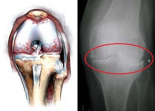 diz ekleminin osteoartriti